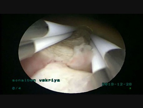 4.5cm SM Fibroid Removal Through Bipolar Resectoscope
