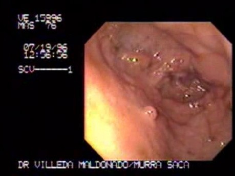 Adenocarcinoma And Gastric Polyps