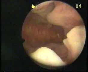 Hysteroscopic Aspect Of Endometrial Hyperplasia