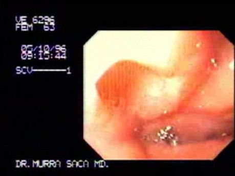 Pseudodiverticular Scar of the Duodenum