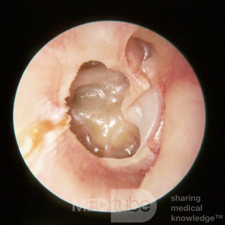 Severe Adhesive OtitisaMedia