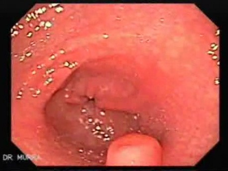 Heterotopic Pancreas and Follicular Lymphoid Hyperplasia (1 of 3)