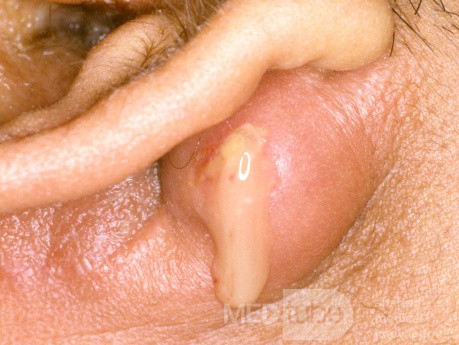 Mastoid Abscess