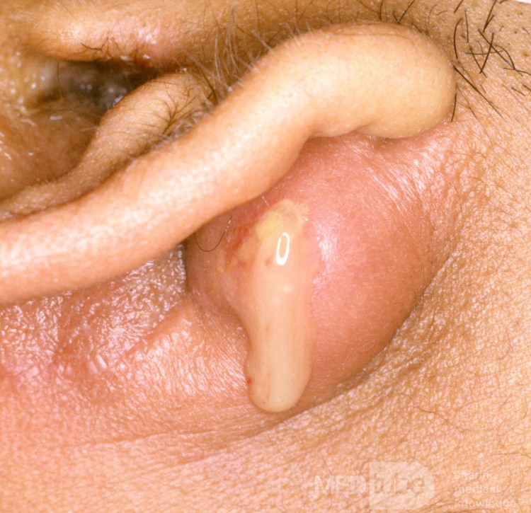 Mastoid Abscess