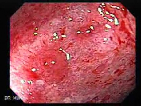 Colonic Lymphoma (3 of 6)