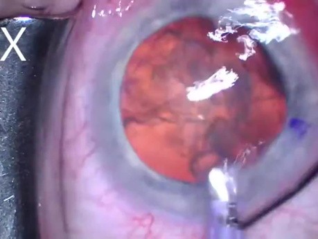 Cataract with Omni Dilation and Hydrus