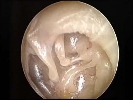 Adhesive Otitis Media - Endoscopic Examination