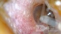 Dermoid Cyst - Comments?