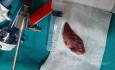 Thoracoscopic Segmentectomy (Lung Cancer)  