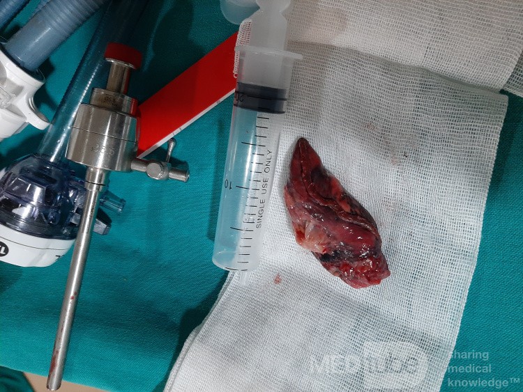 Thoracoscopic Segmentectomy (Lung Cancer)  