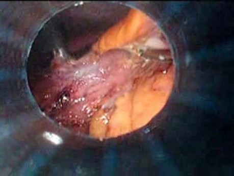 Gastrointestinal Stromal Tumor - GIST (23 of 65)