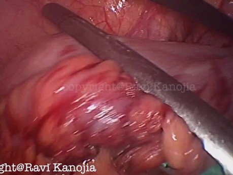 Single Stage Laparoscopic Duhamel's Pull-through for Hirschsprung's Disease