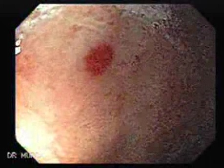 Multiple Gastric Angiodysplasia (1 of 17)