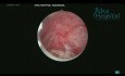 Hysteroscopic Myomectomy of FIGO Type 1 and 2 Fibroids