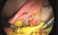 Laparoscopic simulator video