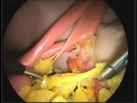 Laparoscopic simulator video