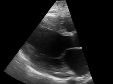 Parasternal Long Axis Echo of a Patient With Dilated Cardiomyopathy