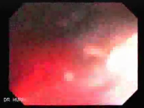Endoscopic Resection of Giant Tubulo-Villous of the rectum (23 of 35)