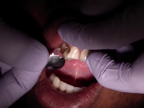 Anterior Composite Metal Kidney Matrix