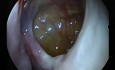 Maxillary Sinus - Infraorbital Nerve