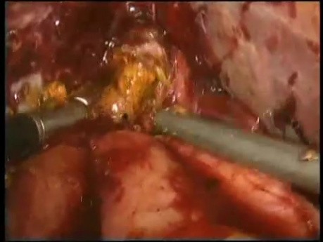 Redo Hepaticojejunostomy - Laparoscopy