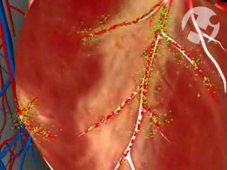 Normal Blood Flow