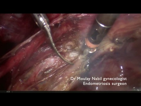 Utero Sacral Ligaments Endometriosis Management