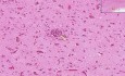 Viral Encephalitis