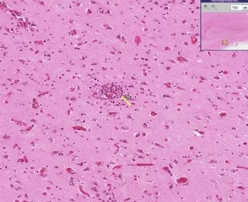 Viral Encephalitis