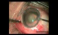 Management of Posterior Capsular Tear