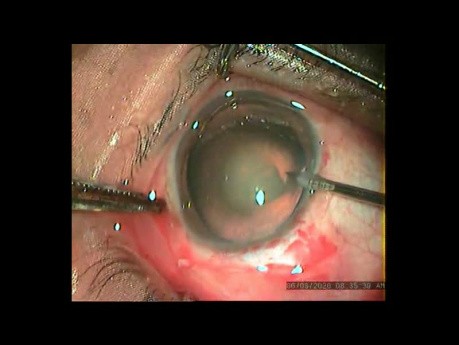 Management of Posterior Capsular Tear