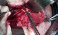 Excision of Pelvic Lymph Nodes for Cervical Cancer