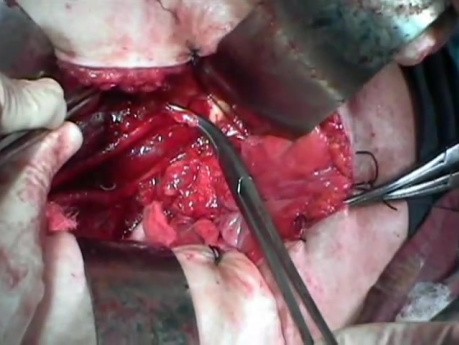 Excision of Pelvic Lymph Nodes for Cervical Cancer