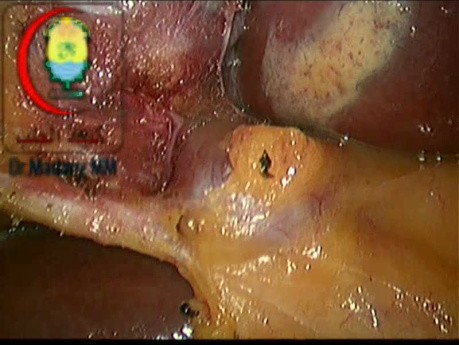 Caterpillar Hump of Rt Hepatic Artery