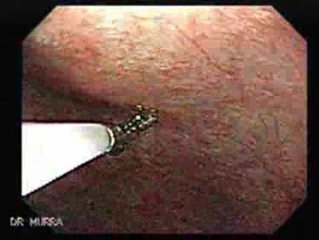 Atrophic Gastritis