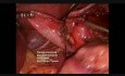 Laparoscopic Nissen Fundoplication 