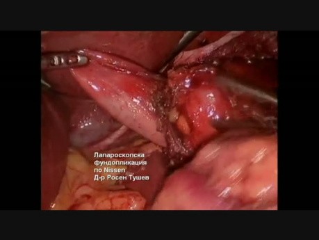 Laparoscopic Nissen Fundoplication 