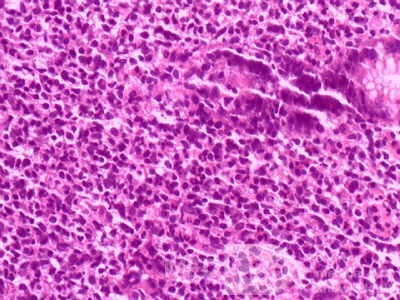 Gastric Lymphoma (9 of 10)