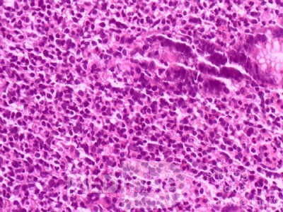 Gastric Lymphoma (9 of 10)