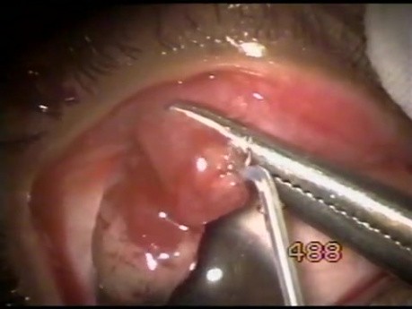 Pedunculated Hemangioma - Fugo Blade Cut