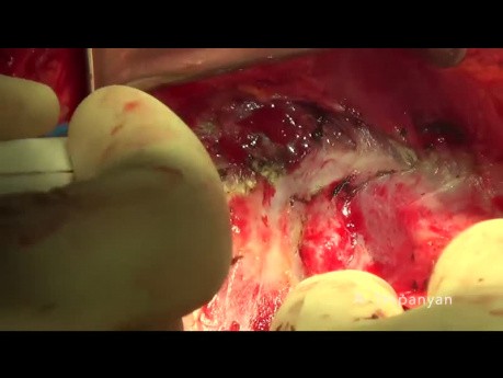 Ovarian Cancer Cytoreductive Surgery. The Diaphragm Stripping.