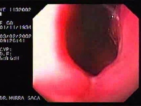 Mallory-Weiss Tear - Ulcer at the Gastroesophageal Junction