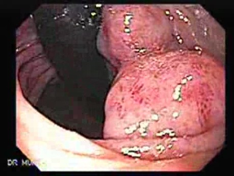 Gastric Lymphoma with Metastases to the Duodenum - Retroflexed View at the Duodenum, Part 1