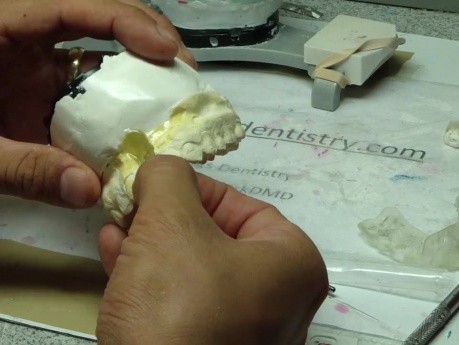 Guided Implant (Nobelguide) Part 8/10 - Esthetic Abutment Cerec