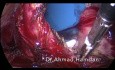 Total Laparoscopic Hysterectomy with Ligasure