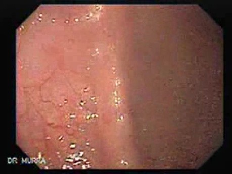 Adenocarcinoma of the Ascending Colon (2 of 2)