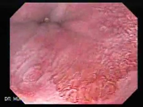 Gastric Heterotopia (inlet pach) (2 of 4)