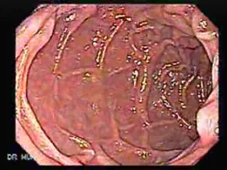 Gastric Lymphoma with Metastases to the Duodenum - Presence of the Post-Bulbar Metastases