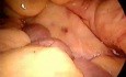 Sigmoid resection - laparoscopy