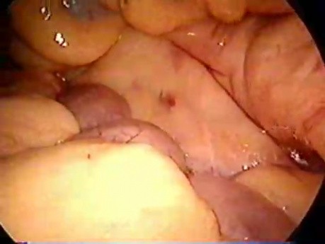 Sigmoid resection - laparoscopy